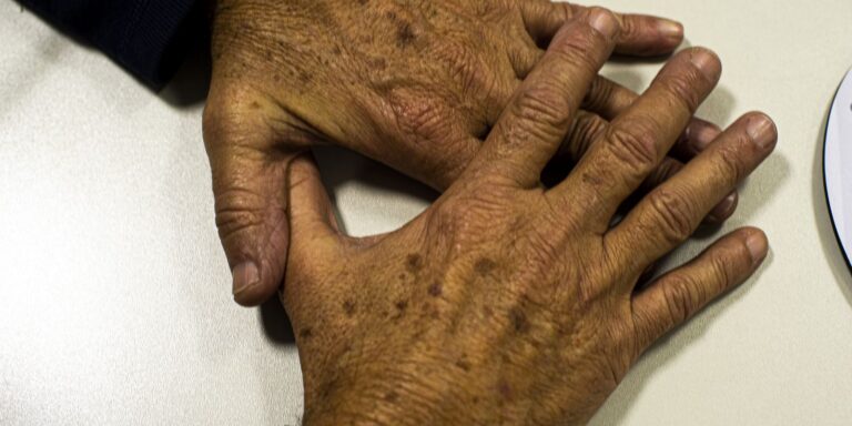 País deve registrar 9 mil novos casos de melanoma, nem sempre na pele pais-deve-registrar-9-mil-novos-casos-de-melanoma,-nem-sempre-na-pele
